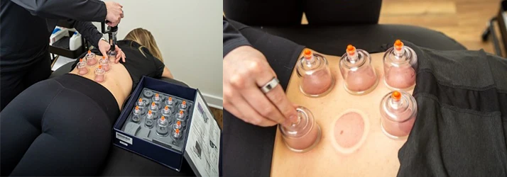 Cupping Therapy Performed by Therapist on a Patient